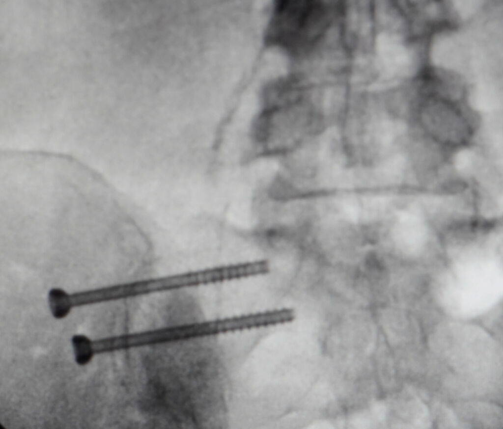 Percutaneous Sacroiliac Fusion instrumentation x-ray