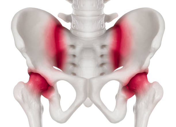 SI hip pain locations shown in red on full pelvis diagram