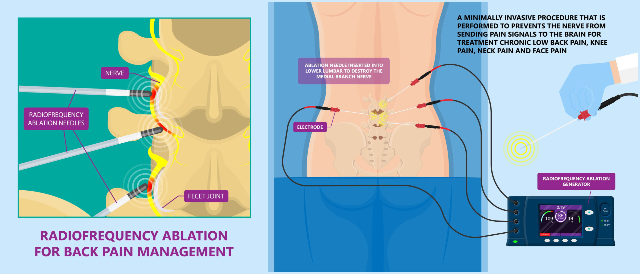 Radiofrequency Ablation Diagram