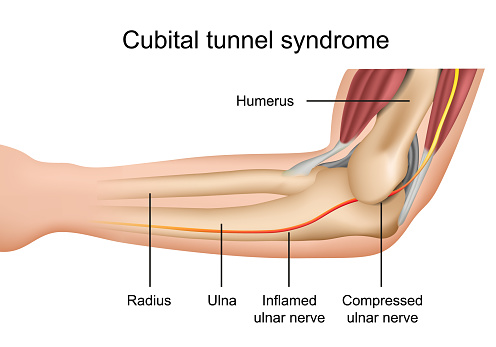 Cubital Tunnel Syndrome, inflamed ulnar nerve medical vector illustration