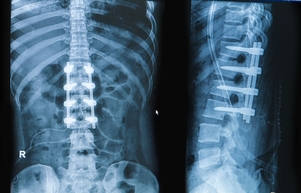 Spinal Fusion instrumentation x-ray