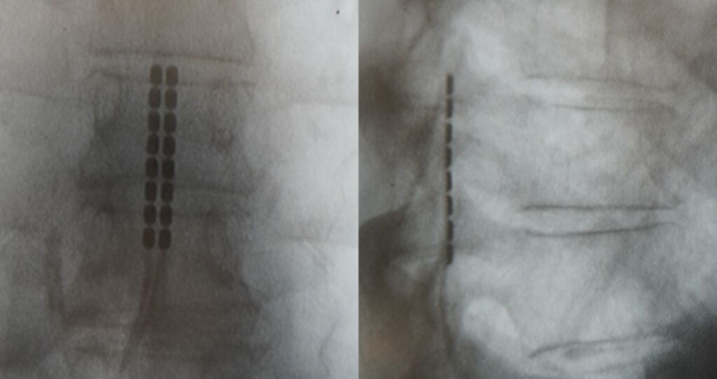 Spinal Cord Stimulators, AP and Lateral