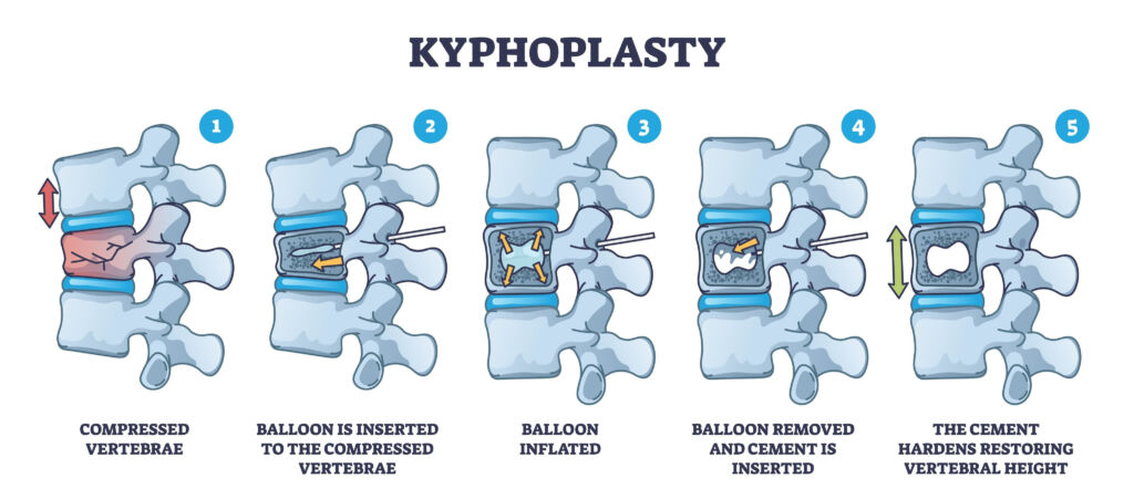 Diagram of Kyphoplasty Operations